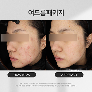 여드름 시술전후