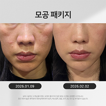 모공흉터 시술전후