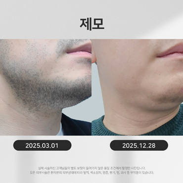 제모 시술전후